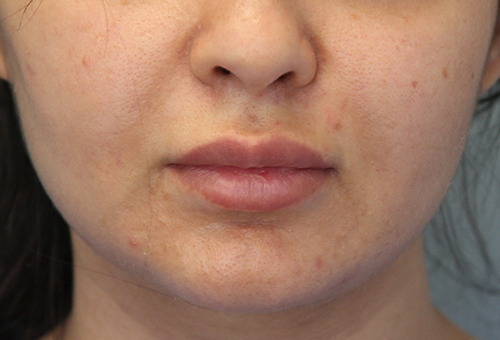 Restylane Patient 29618 Before Photo