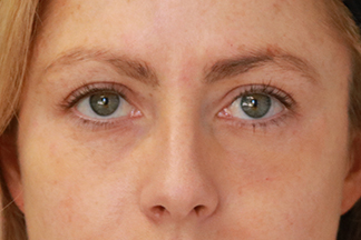 Juvederm Volbella Patient 30163 After Photo