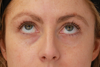 Juvederm Volbella Patient 30163 Before Photo