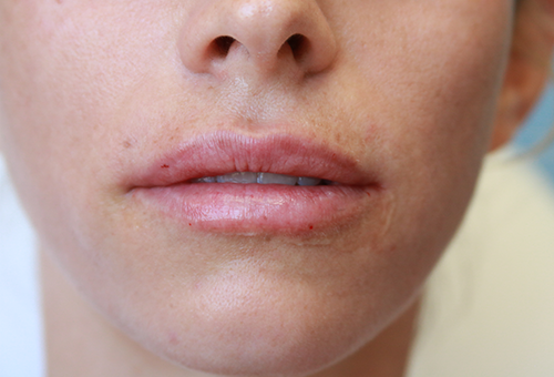 Juvederm Volbella Patient 29367 After Photo