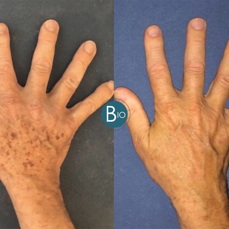 hand rejuvenation before & after