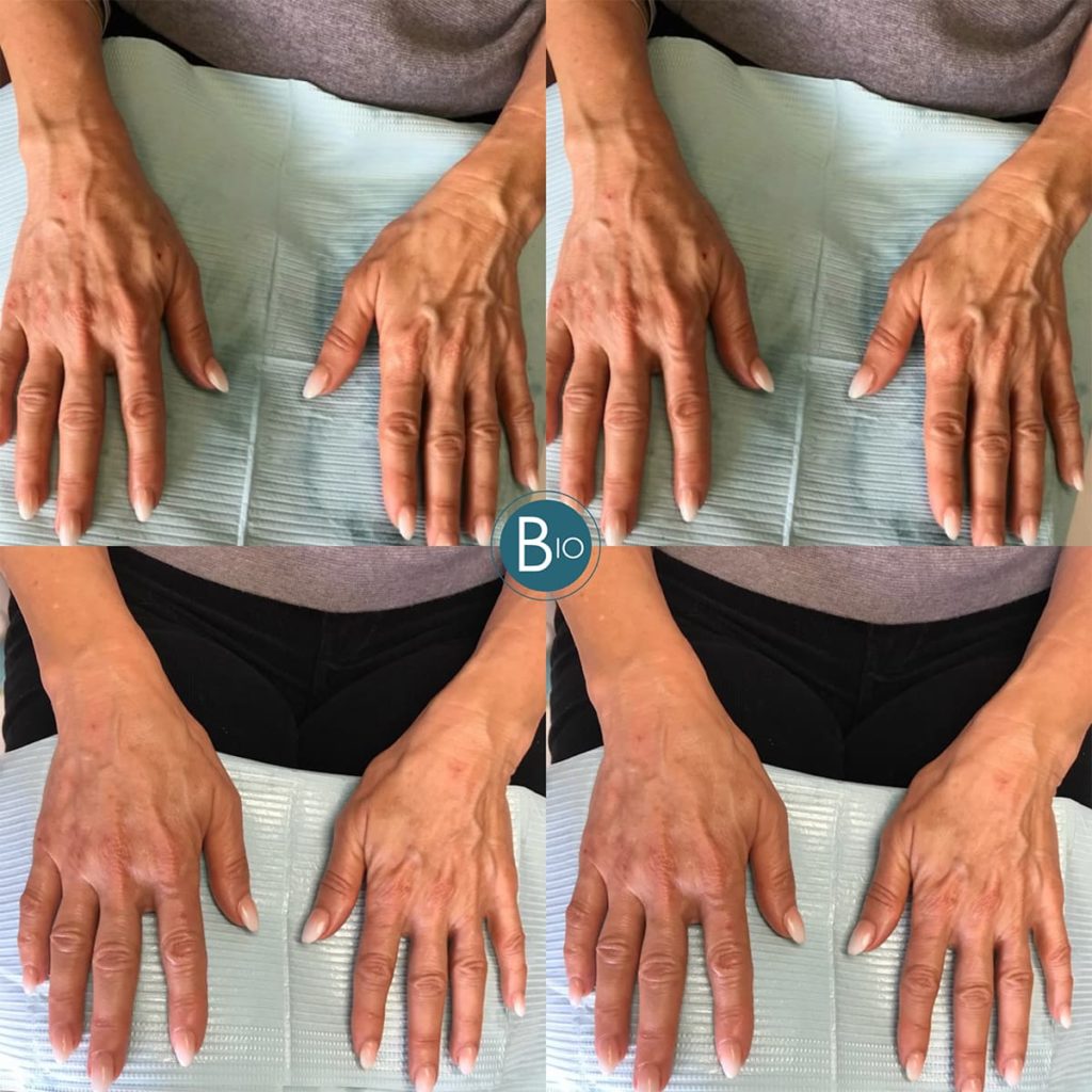 hand rejuvenation before & after