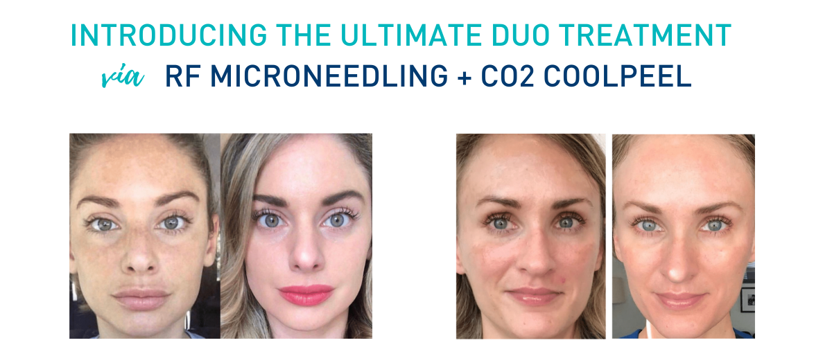 Rejuvenate your skin with our Carbon Dioxide Laser treatment