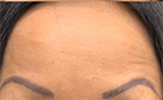 BOTOX for Forehead Lines After Photo