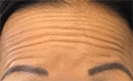 BOTOX for Forehead Lines Before Photo