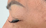 BOTOX for Crow's Feet After Photo