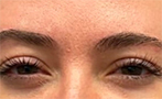 BOTOX for Frown Lines After Photo