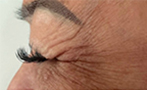 BOTOX for Crow's Feet Before Photo