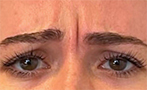 BOTOX for Frown Lines Before Photo