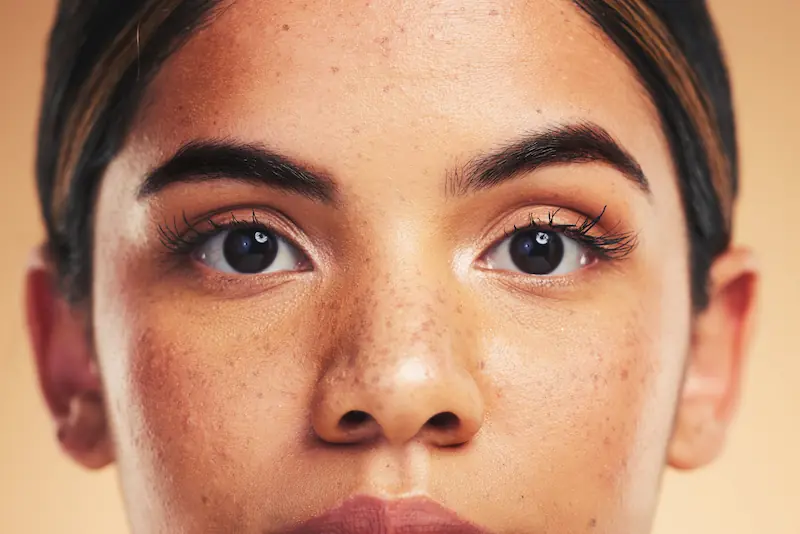 melasma skin on womans face