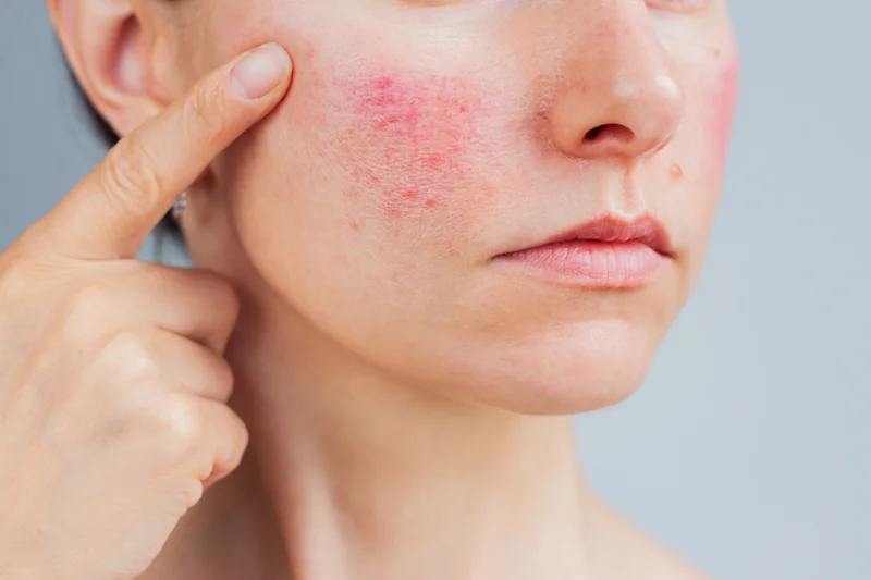 rosacea skin on womans face